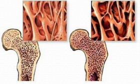 VISITA PER OSTEOPOROSI a Milano, Monza e Como CON QUALIFICATO MEDICO FISIATRA - FISIATRA per VISITA FISIATRICA